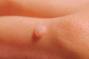 Skin Tag Treatment: Effective Ways to Remove Skin Tags on Face