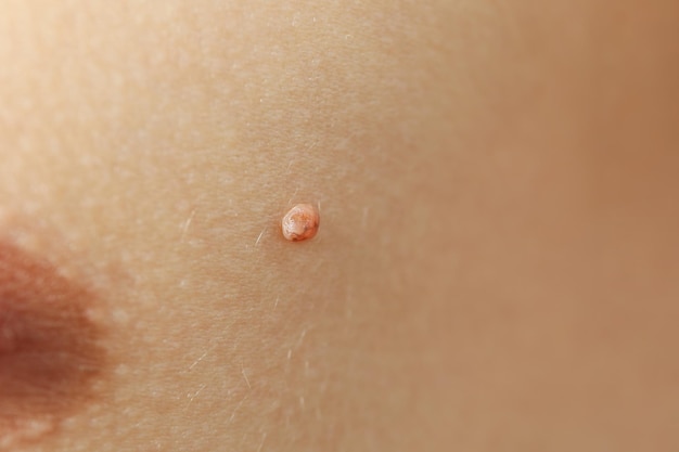 Laser Treatment for Skin Tags: Safe Solutions for Removal