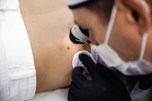 Skin Moles Treatment: Safe Ways to Treat and Remove Moles
