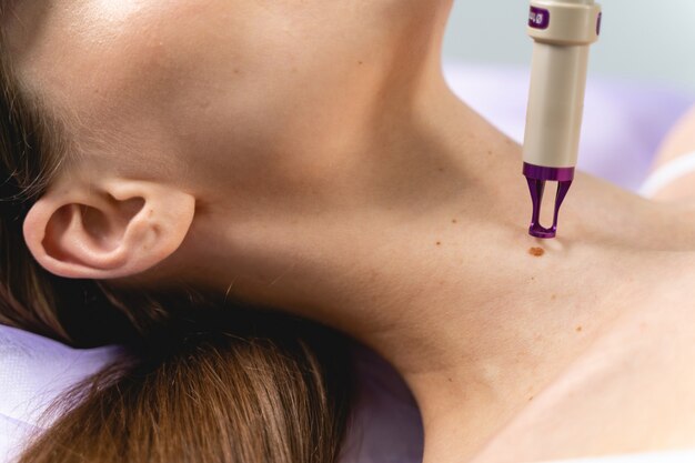 How Laser Treatment for Moles Is Changing Skin Care