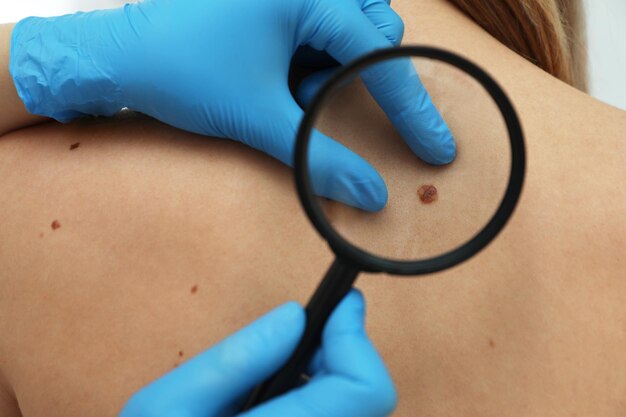 Mole Removal Laser Treatment Cost: What to Expect
