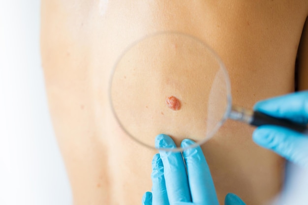 Mole Removal Laser Treatment Cost: What to Expect
