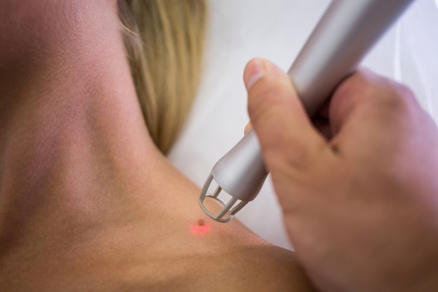 Laser Treatment for Moles: Pros, Cons & What to Expect