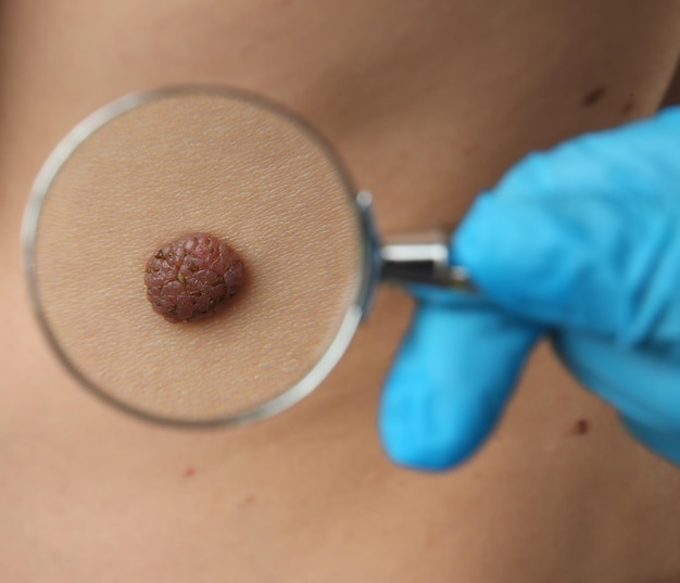 Laser Treatment for Removing Moles: Benefits & Costs
