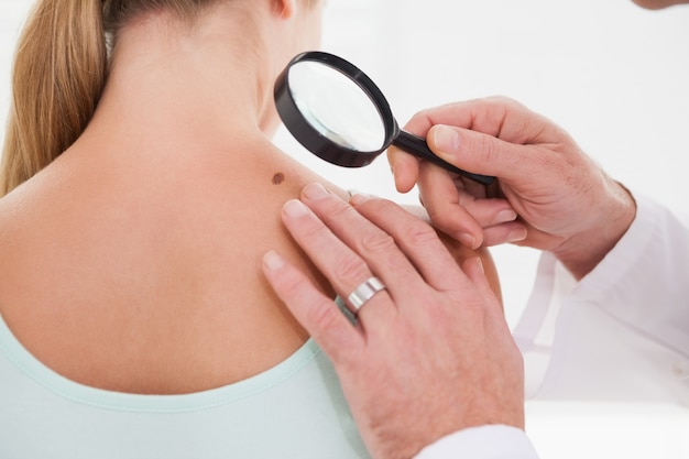 Mole Removal Treatment: Safe Solutions for All Types of Moles
