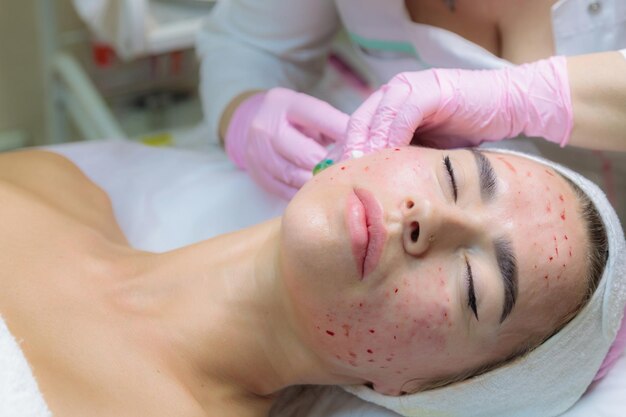 Microdermabrasion Treatment for Acne Scars: Does It Work?