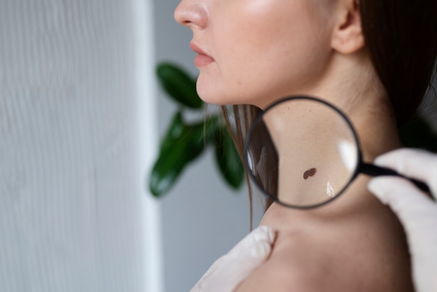 Skin Moles Treatment: Safe Ways to Treat and Remove Moles