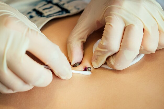 Brown Moles on Face Treatment: Best Options for Removal