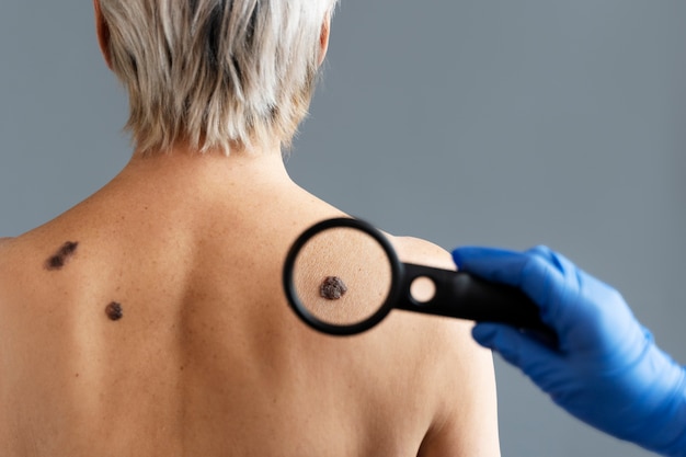 Black Mole Treatment: How to Safely Remove and Treat Moles