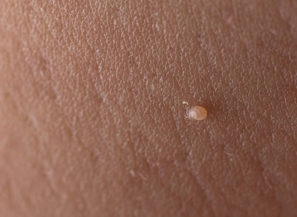 Skin Tag Treatment: Effective Ways to Remove Skin Tags on Face