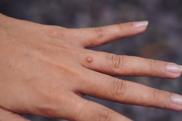 Brown Moles on Face Treatment: Best Options for Removal