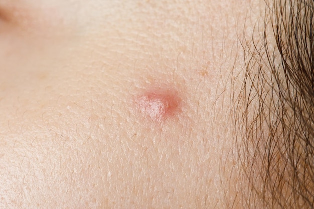 Laser Treatment for Skin Tags: Safe Solutions for Removal