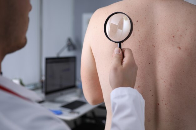 Brown Moles on Face Treatment: Best Options for Removal