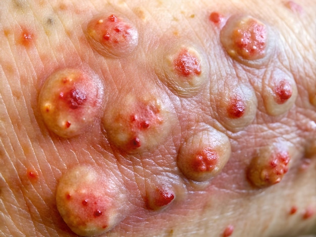 Skin Warts Treatment: Effective Methods to Treat Warts