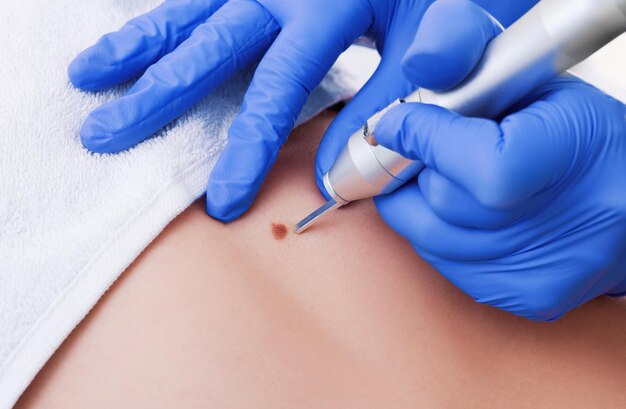 Laser Treatment for Removing Moles: Benefits & Costs