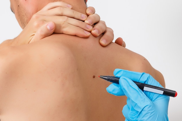 Skin Moles Treatment: Safe Ways to Treat and Remove Moles
