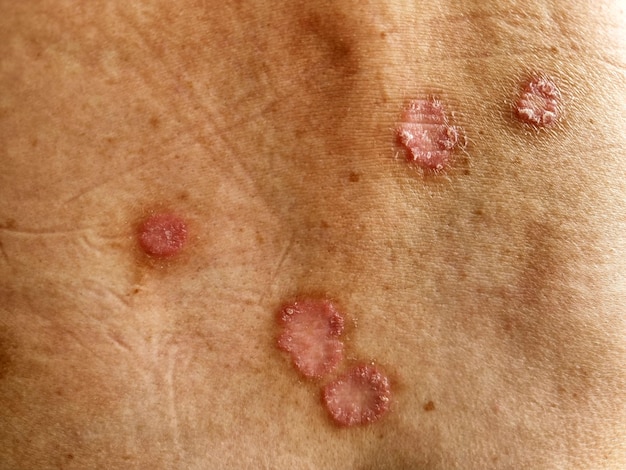 Skin Warts Treatment: Effective Methods to Treat Warts
