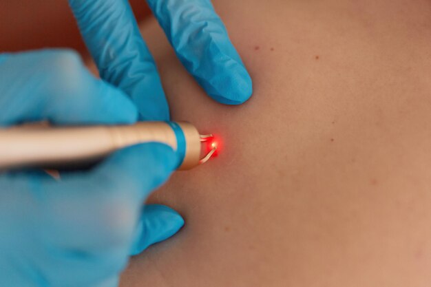 Brown Moles on Face Treatment: Best Options for Removal
