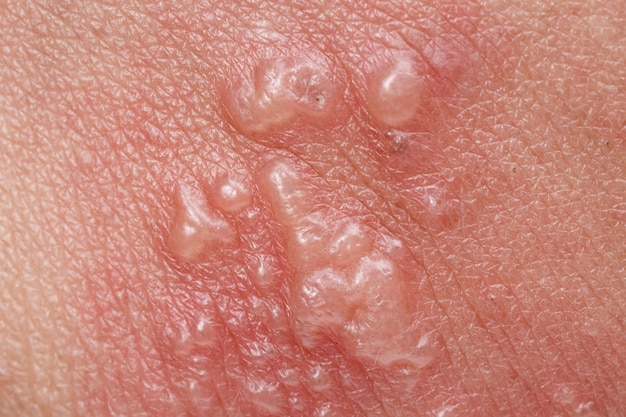Skin Warts Treatment: Effective Methods to Treat Warts