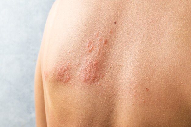 Skin Warts Treatment: Effective Methods to Treat Warts