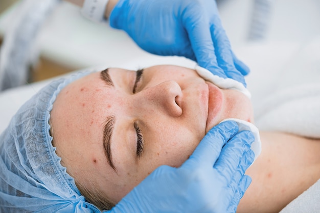 Microdermabrasion Treatment for Acne Scars: Does It Work?