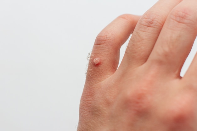 Mole Removal Laser Treatment Cost: What to Expect
