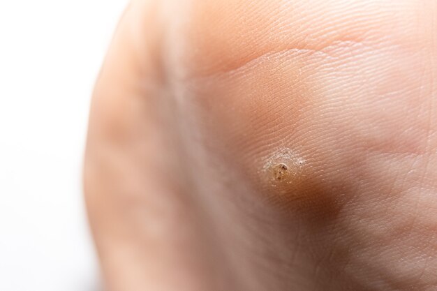 Skin Warts Treatment: Effective Methods to Treat Warts