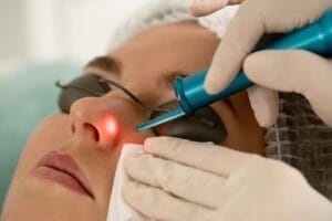 Laser Treatment for Moles on Face: Side Effects Explained