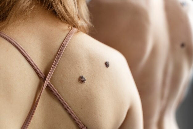 Laser Treatment for Skin Tags: Safe Solutions for Removal