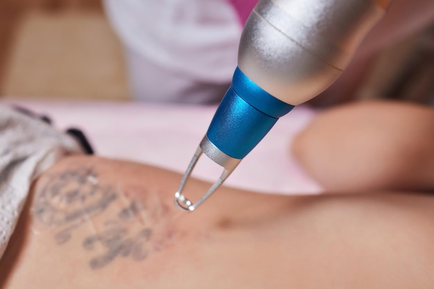 How Laser Ablation Helps Remove Skin Imperfections in Islamabad