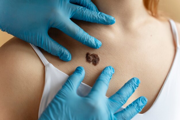 Black Mole Treatment: How to Safely Remove and Treat Moles