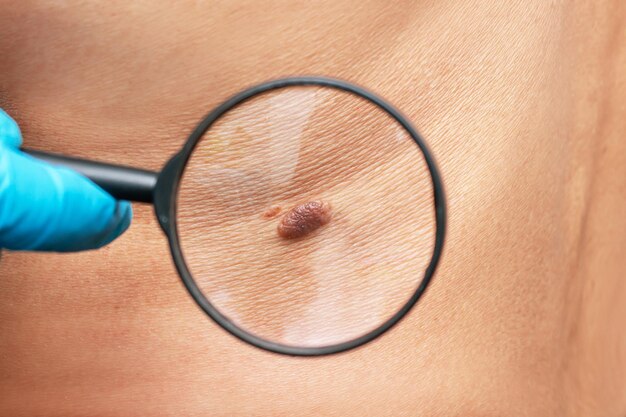Laser Ablation: The Ultimate Solution for Skin Tags and Moles