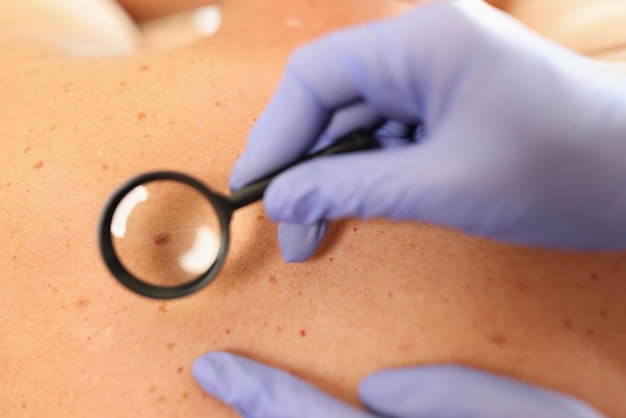 Laser Ablation: The Ultimate Solution for Skin Tags and Moles