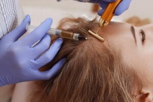 Why Islamabad Residents Prefer PRP for Hair Restoration