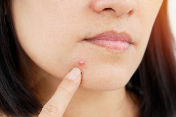Treatment of Moles on Face: Safe and Effective Methods
