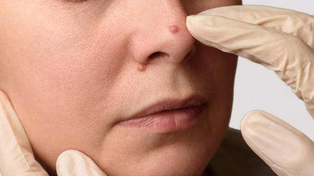Treatment of Moles on Face: Safe and Effective Methods
