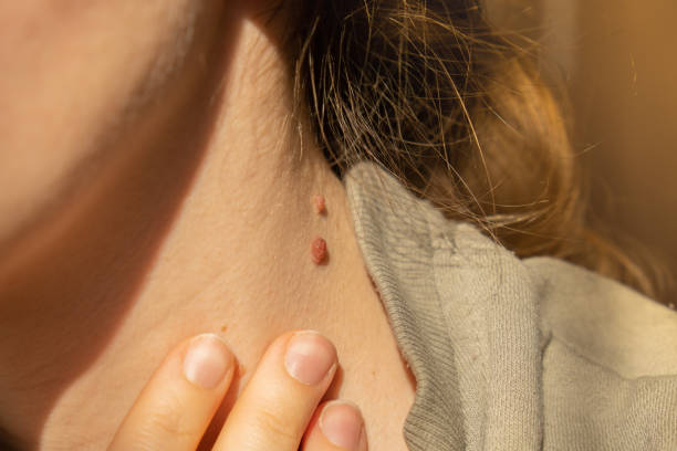 Treatment of Moles on Face: Safe and Effective Methods