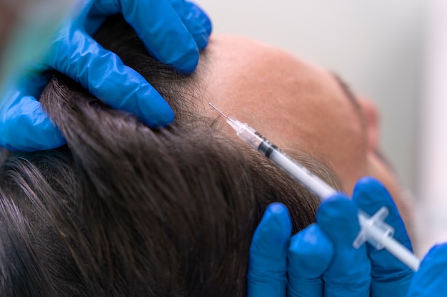 Top Questions About PRP Hair Treatment Answered