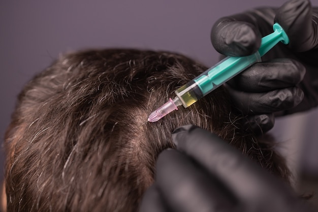 Why Islamabad Residents Prefer PRP for Hair Restoration