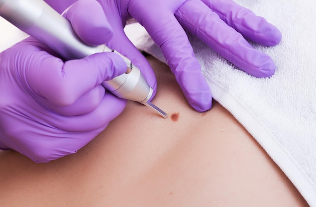 The Science Behind Laser Treatment for Warts and Skin Tags