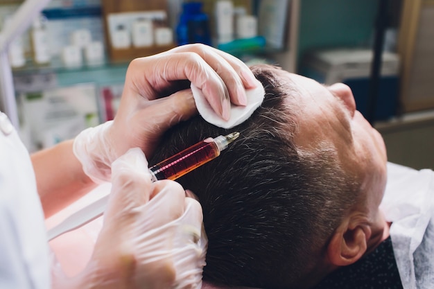Top Questions About PRP Hair Treatment Answered