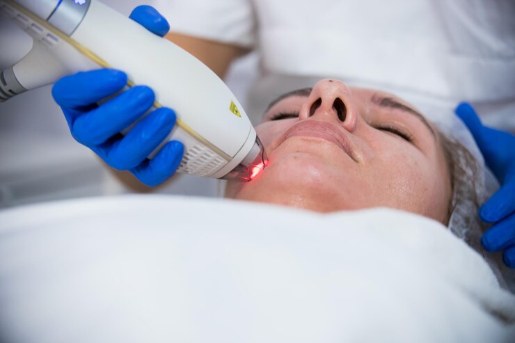 Q-Switch Laser: A Safe Way to Treat Skin Imperfections 